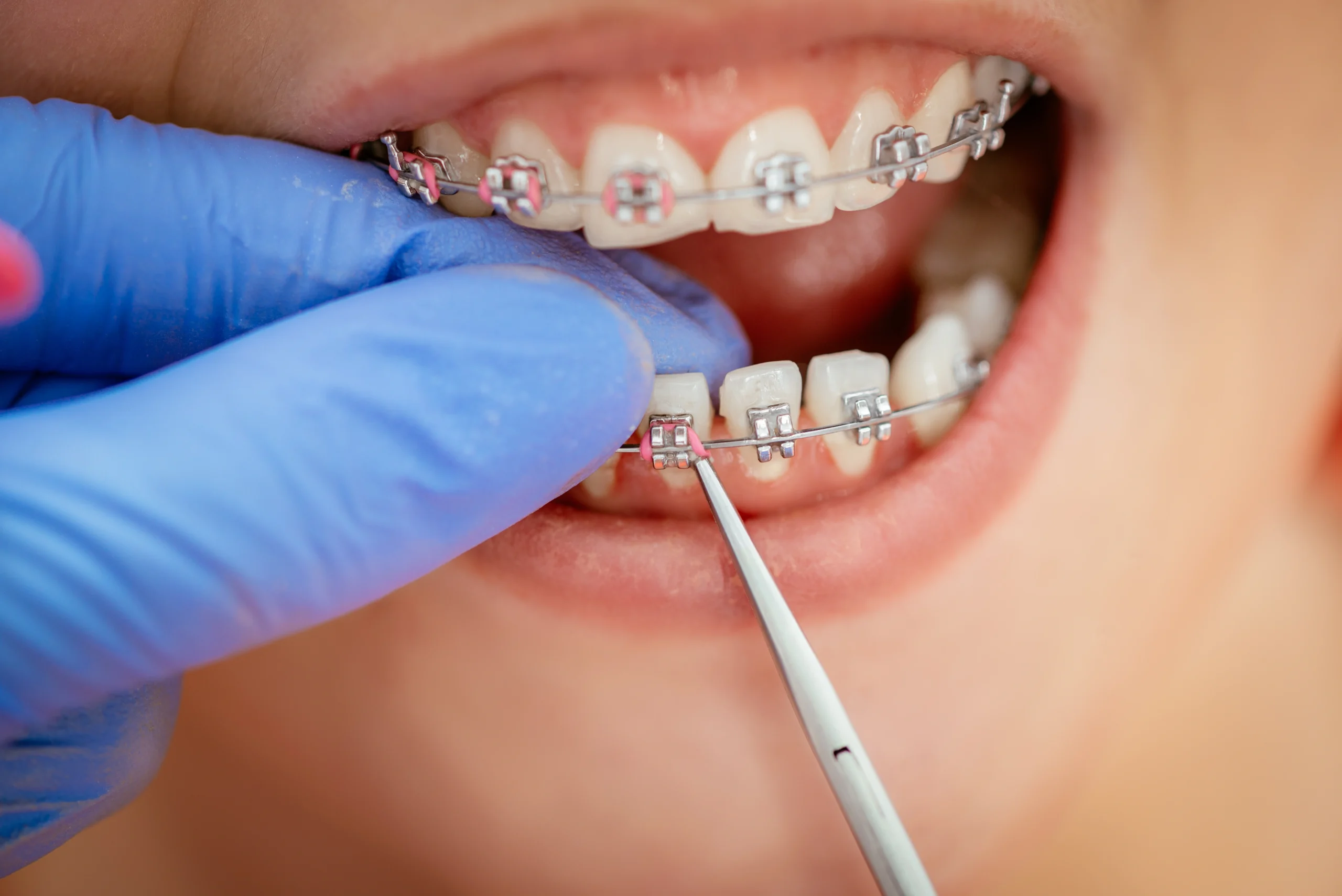 dental implants 