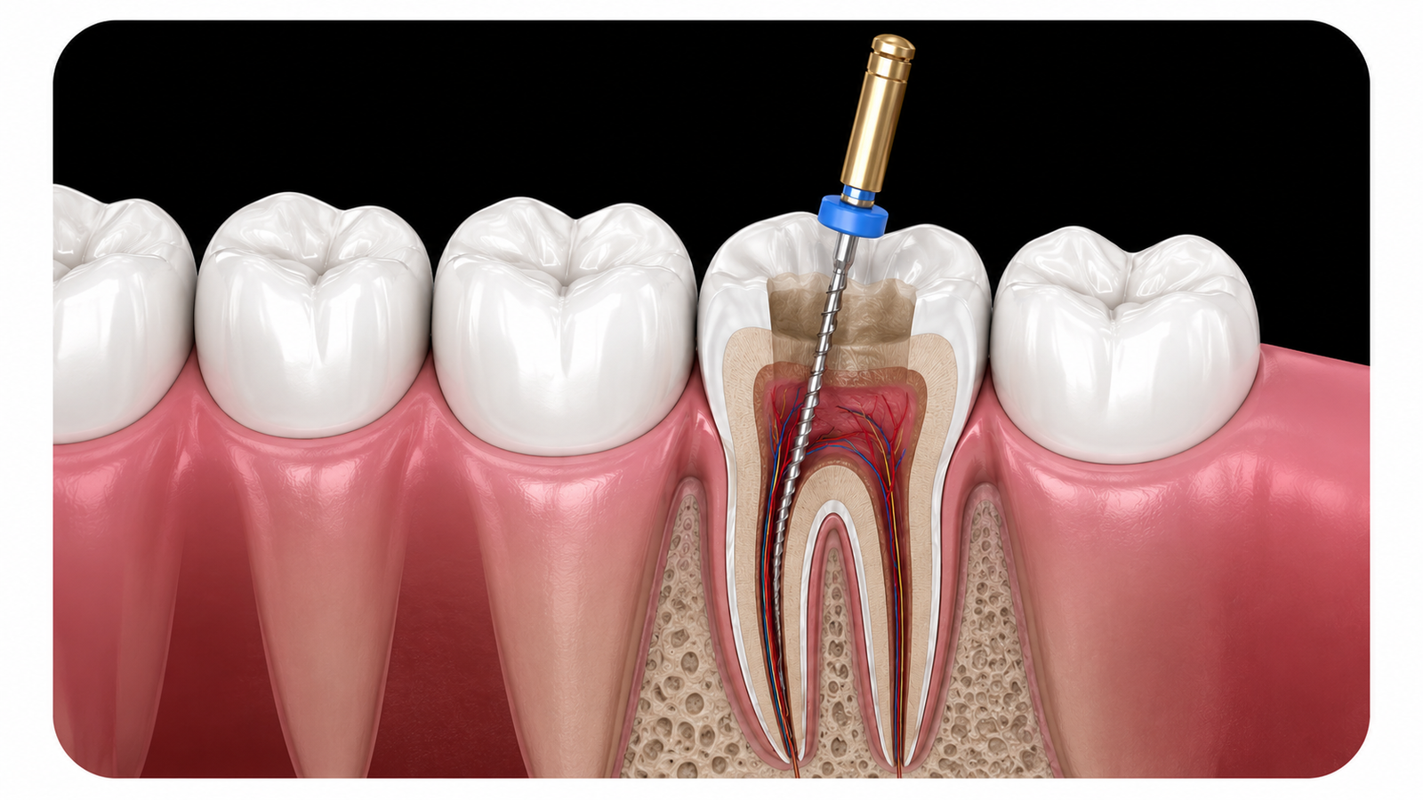 Dental Implants 