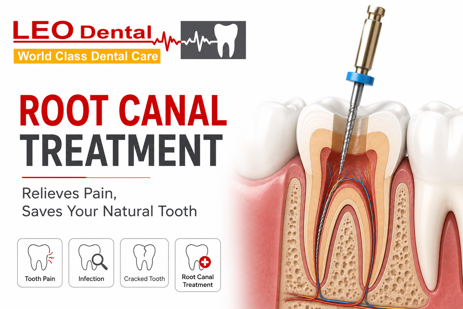 How to Know If You Need a Root Canal Treatment?