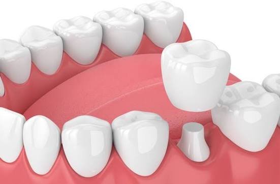 Dental Implants 
