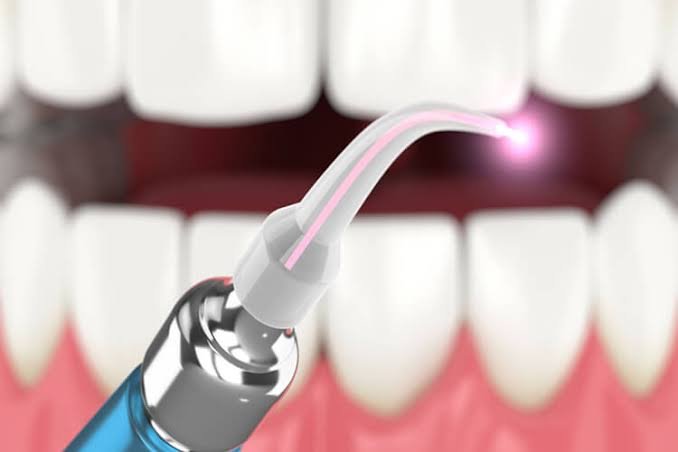 Dental Implants 